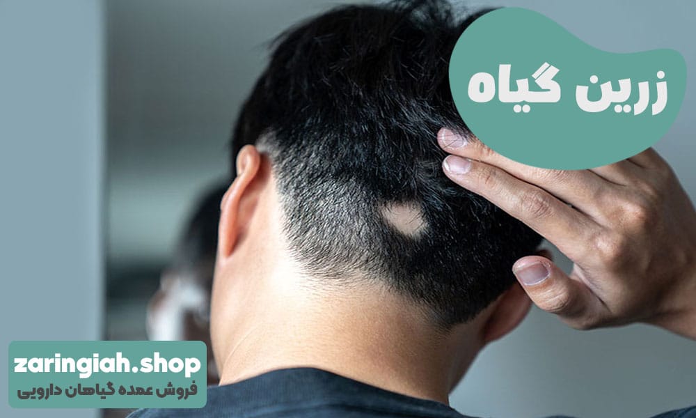 درمان ریزش مو سکه‌ ای با گیاه دارویی