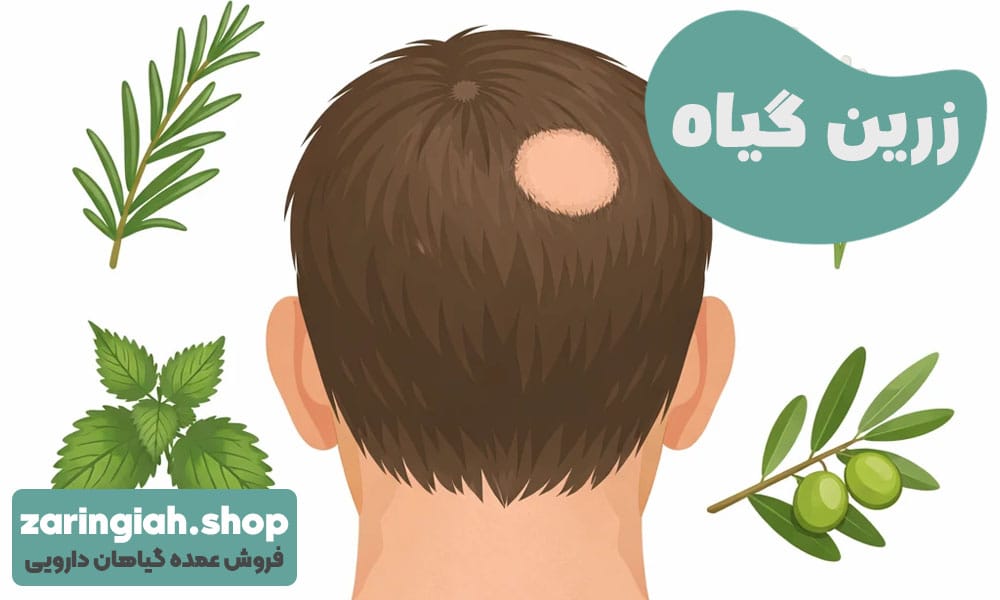 درمان ریزش سکه ای مو با گیاهان دارویی